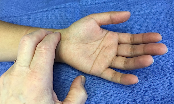 Impulsion Radiale Ressource Sur La Chirurgie De La Main impulsion-radiale-ressource-sur-la-chirurgie-de-la-main